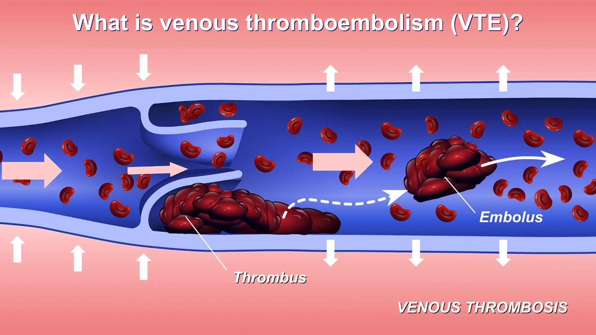 Тромб у кота. Венозная тромбоэмболия. Тромбоз или тромбоэмболия.
